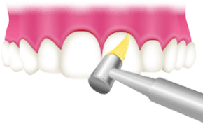 歯と歯の隙間と歯面の清掃