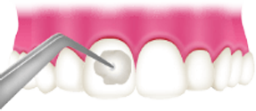 歯仕上げのポリリン酸塗布